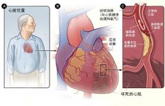 冠心病的起因是什么？